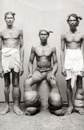 Men with Lymphatic Filariasis Elephantiasis Swollen Limbs Vtg. Photo 19thC.