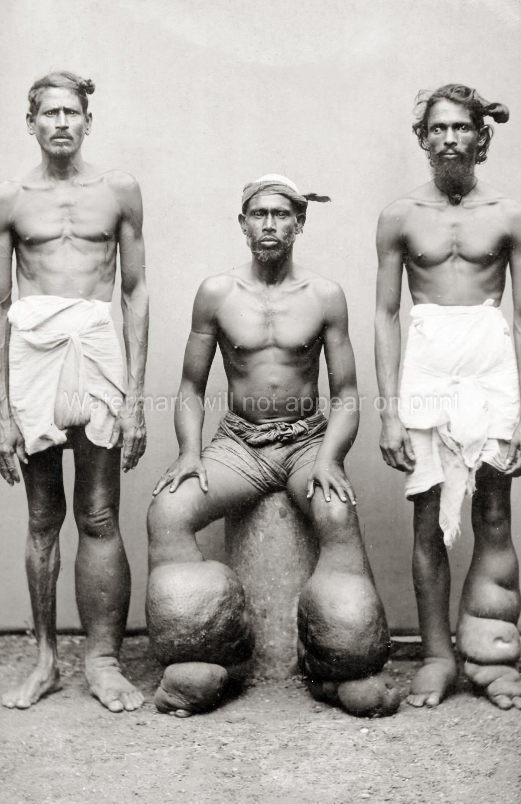Men with Lymphatic Filariasis Elephantiasis Swollen Limbs Vtg. Photo 19thC.